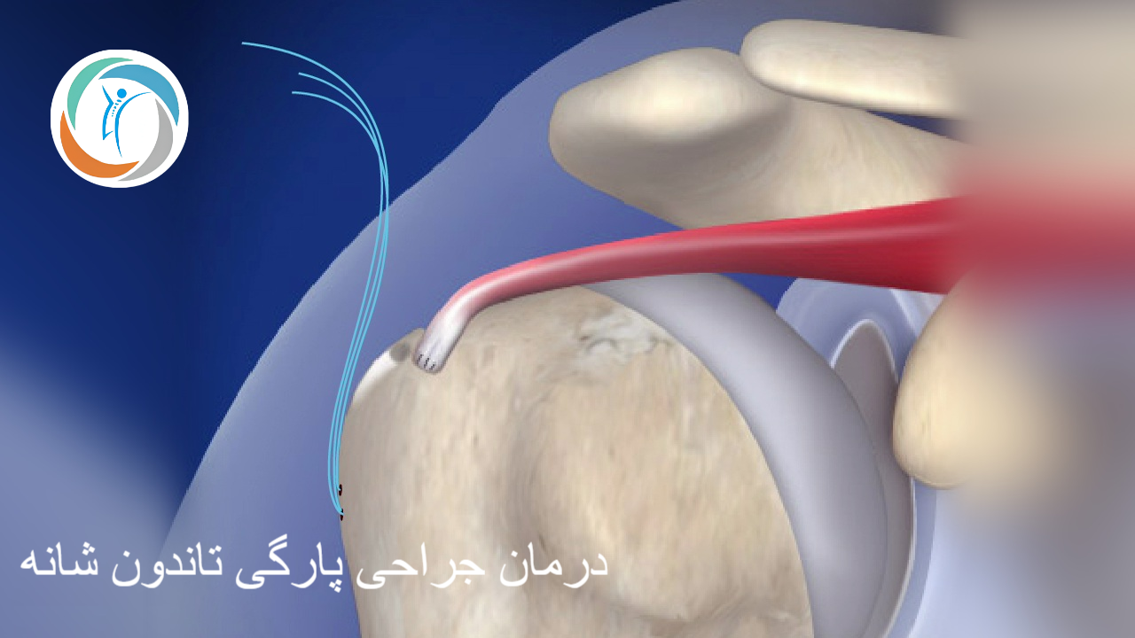 درمان جراحی پارگی تاندون شانه