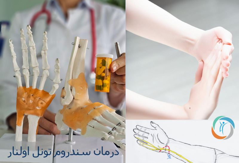 درمان سندروم تونل اولنار