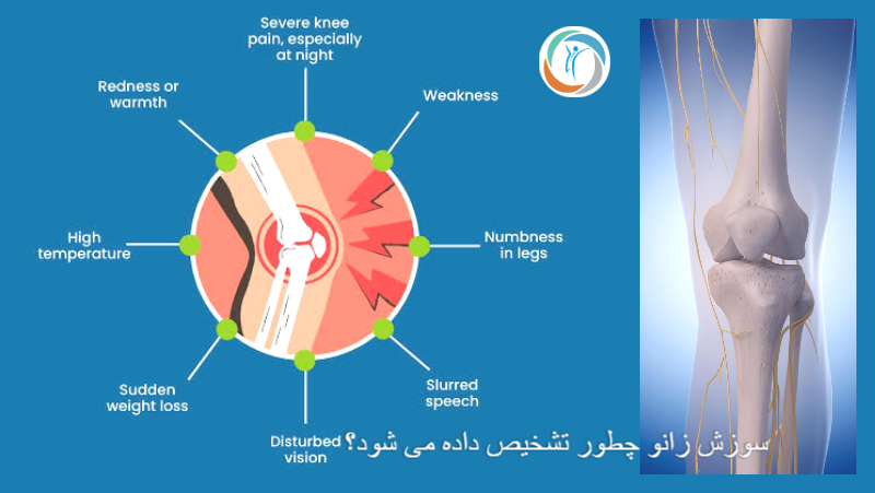 سوزش زانو چطور تشخیص داده می شود؟