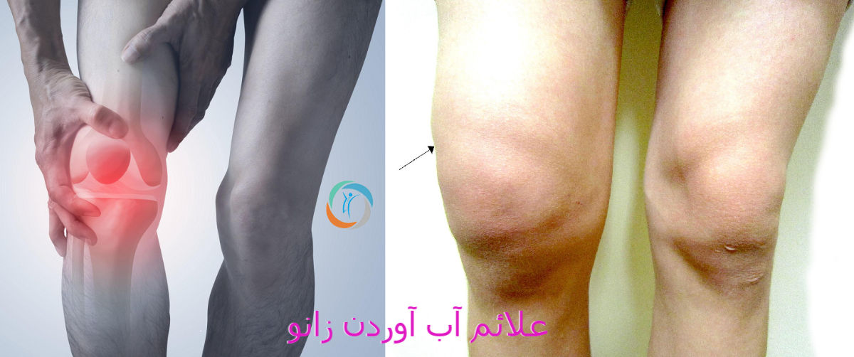 علائم آب آوردن زانو