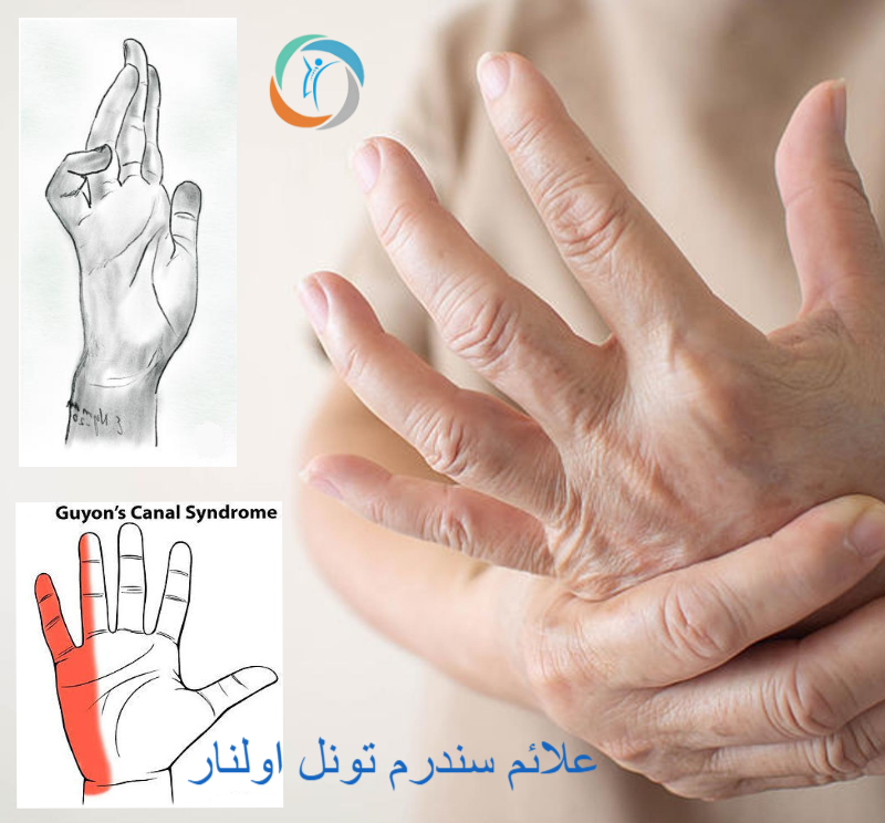 علائم سندرم تونل اولنار