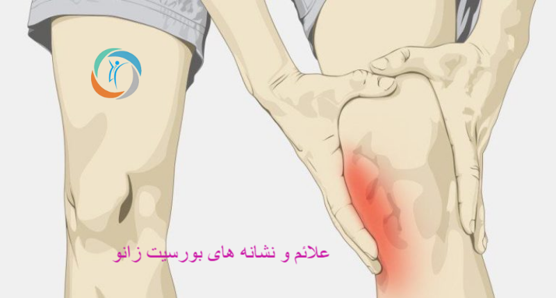 علائم و نشانه های بورسیت زانو