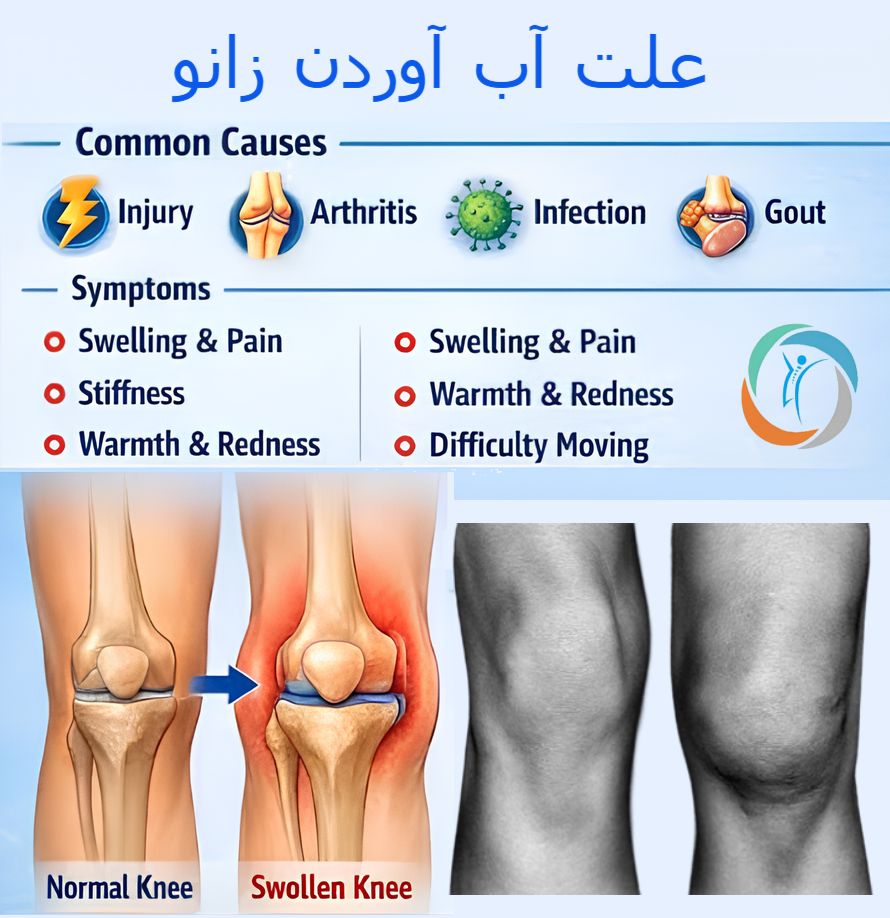 علت آب آوردن زانو