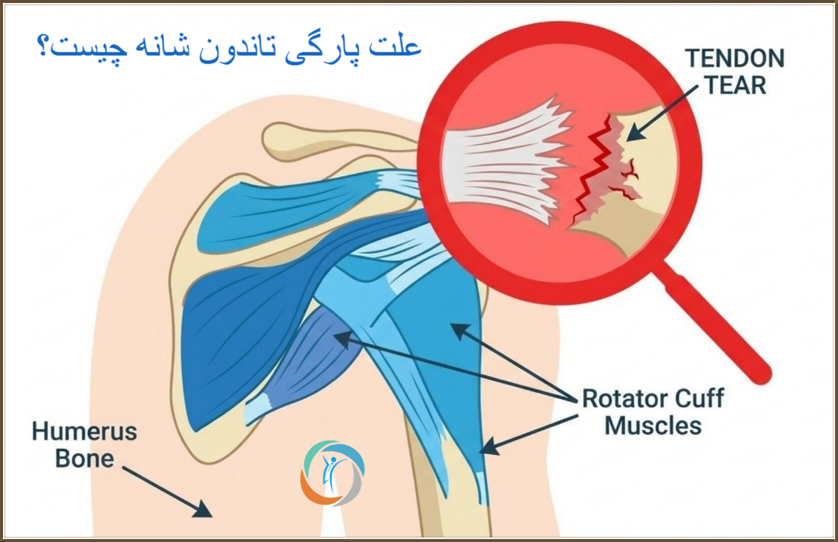 علت پارگی تاندون شانه چیست؟