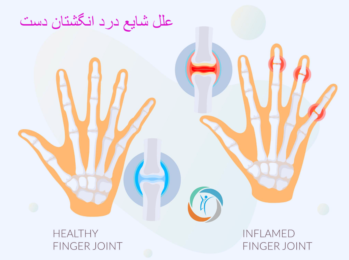 علل شایع درد انگشتان دست