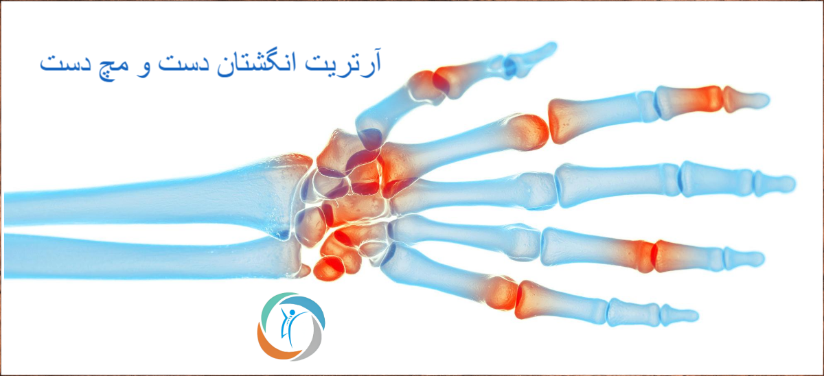 علت آرتریت انگشتان دست چیست؟