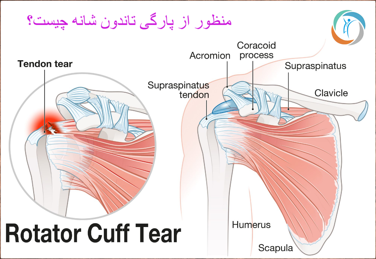 منظور از پارگی تاندون شانه چیست؟