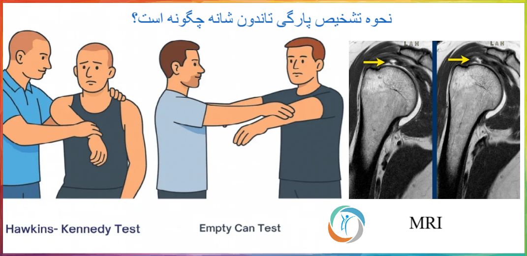 نحوه تشخیص پارگی تاندون شانه چگونه است؟