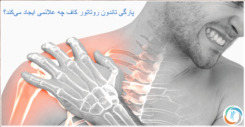 پارگی تاندون روتاتور کاف چه علائمی ایجاد می‌کند؟