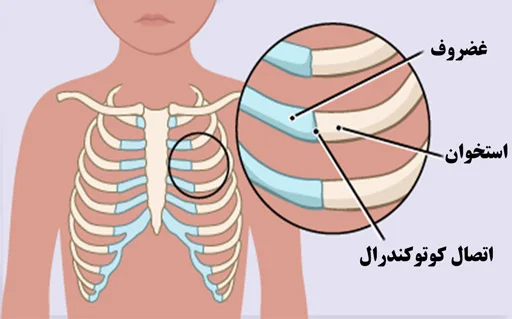 کوستوکندریت