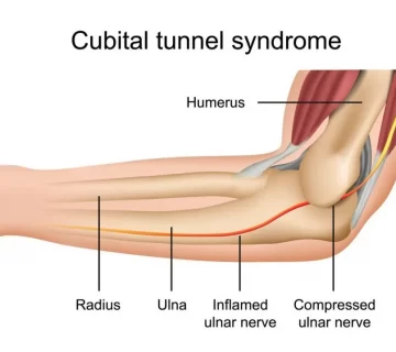 سندروم تونل کوبیتال