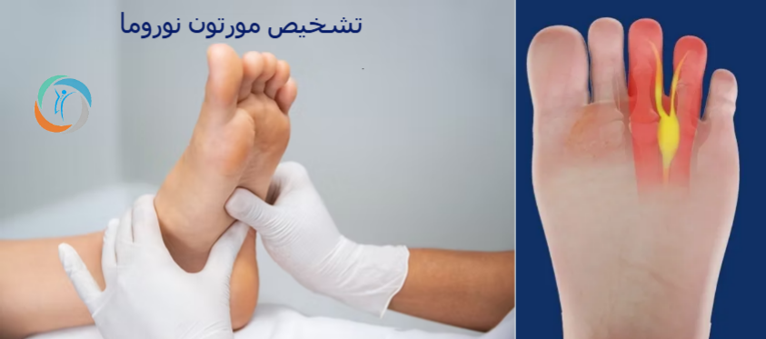 تشخیص مورتون نوروما