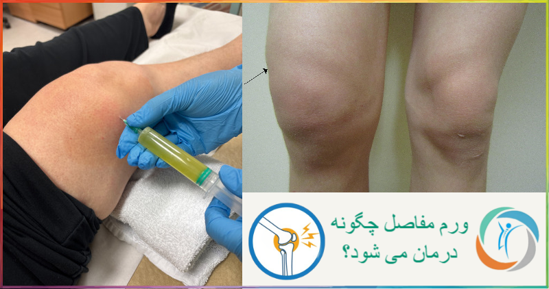 ورم مفاصل چگونه درمان می‌شود؟