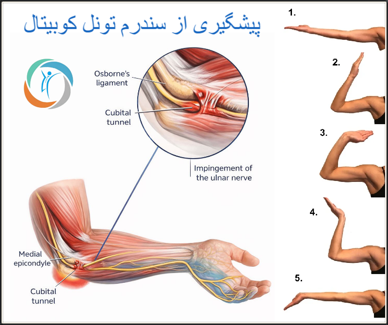 پیشگیری از سندرم تونل کوبیتال