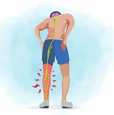 درمان سیاتیک/ بهترین درمان غیر جراحی سیاتیک