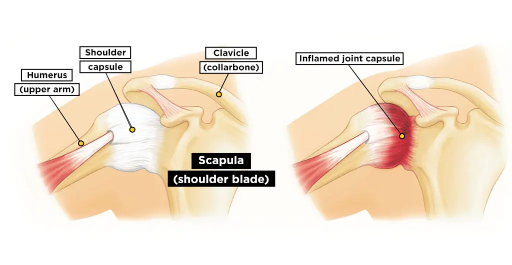 شانه یخ زده