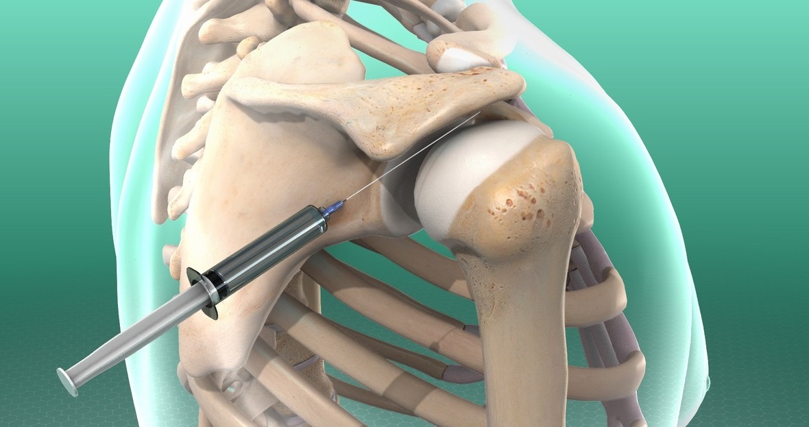 شانه یخ زده