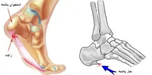 درمان خار پاشنه توسط بهترین دکتر