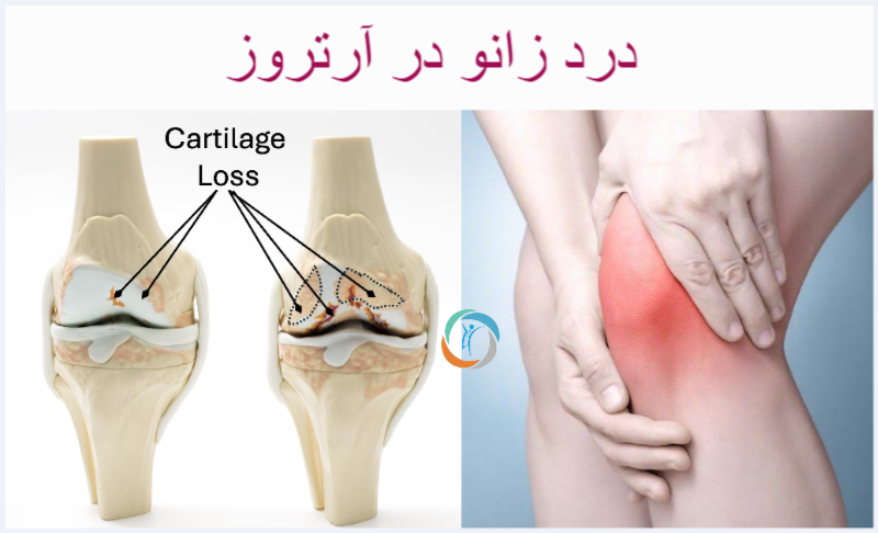 درد زانو در آرتروز