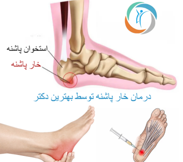 درمان خار پاشنه توسط بهترین دکتر