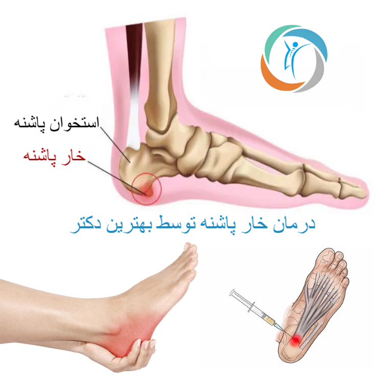 درمان خار پاشنه توسط بهترین دکتر