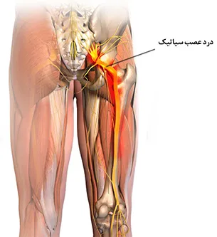 سیاتیک پای راست