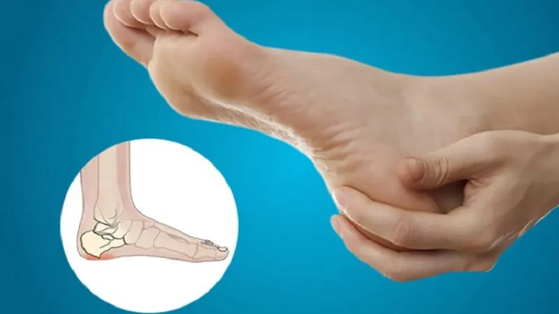 درمان قطعی خار پاشنه