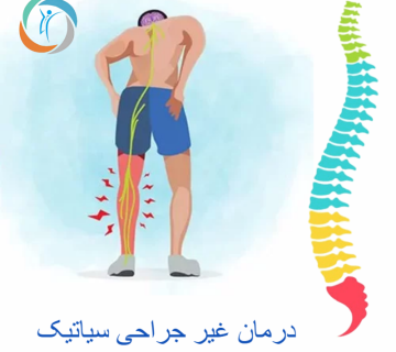 درمان غیر جراحی سیاتیک