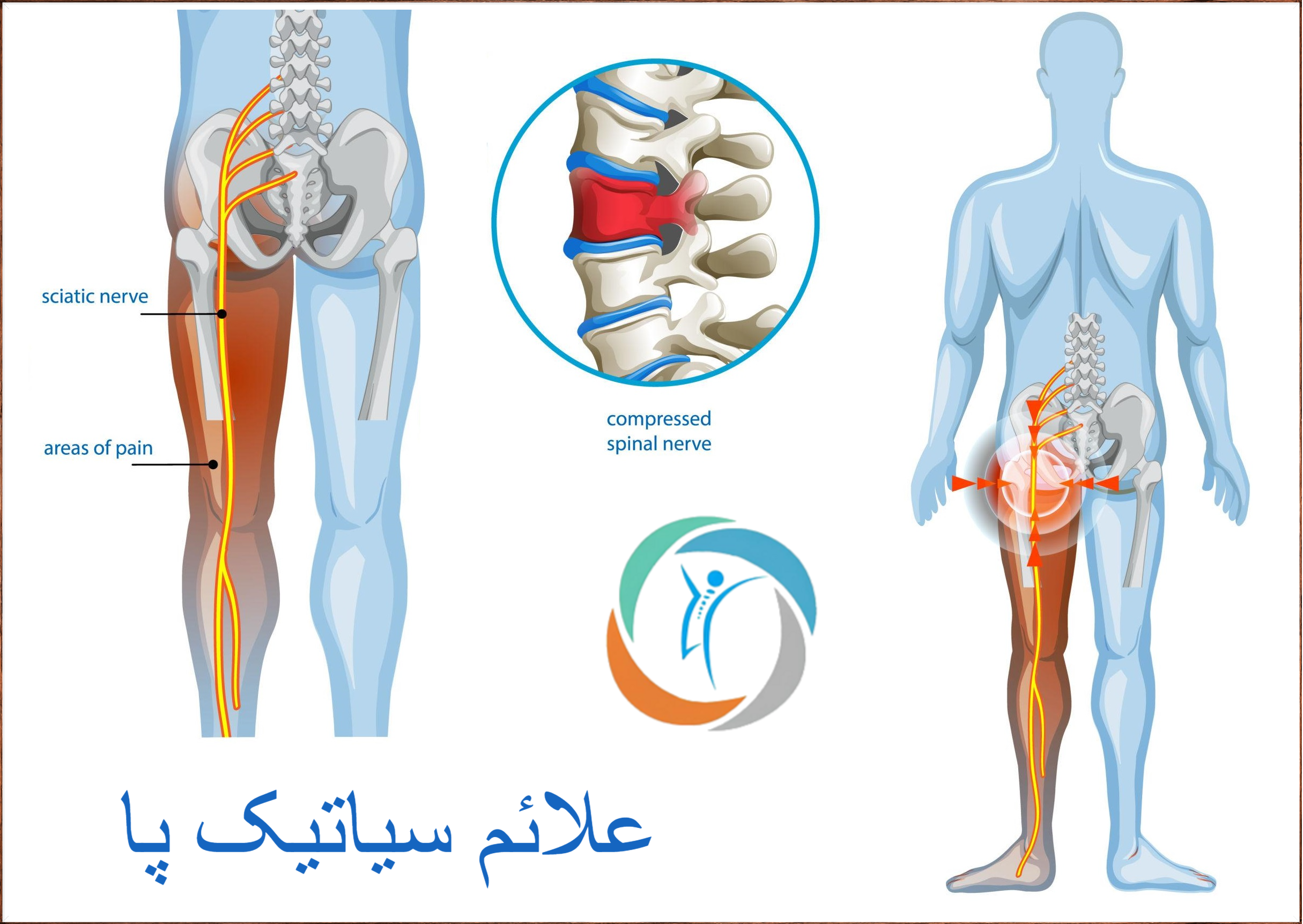 علائم سیاتیک پا