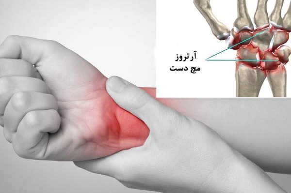 درمان آرتروز دست