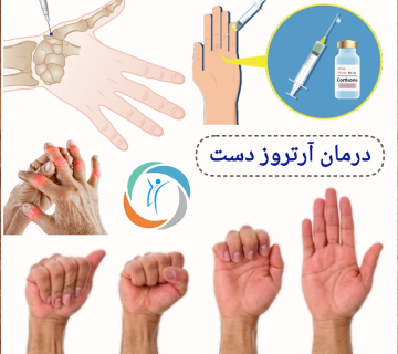 درمان آرتروز دست