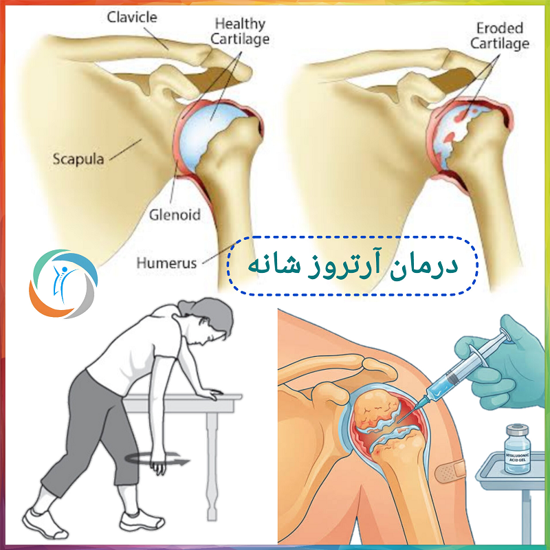 درمان آرتروز شانه