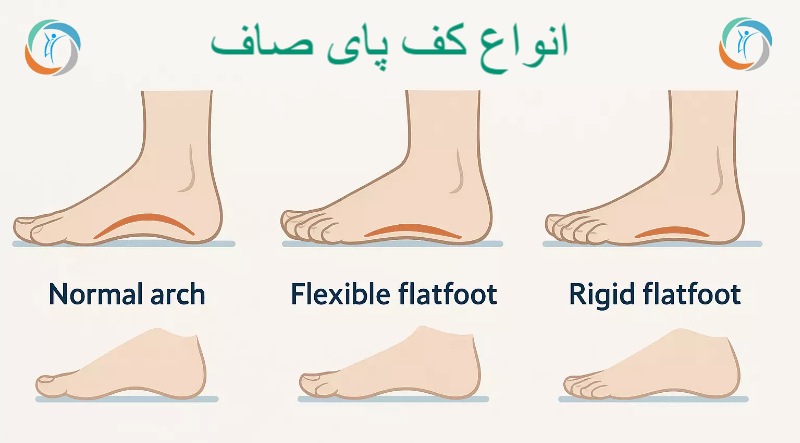 انواع کف پای صاف