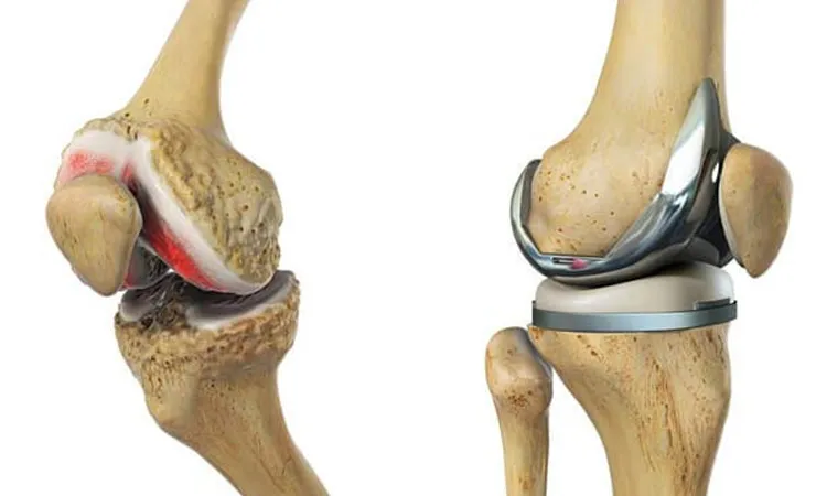 بهترین درمان آرتروز