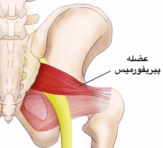 درمان سندرم پیریفورمیس