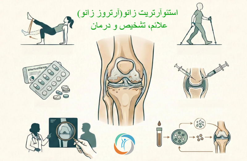 استئوآرتریت زانو(آرتروز زانو)؛ علائم، تشخیص و درمان