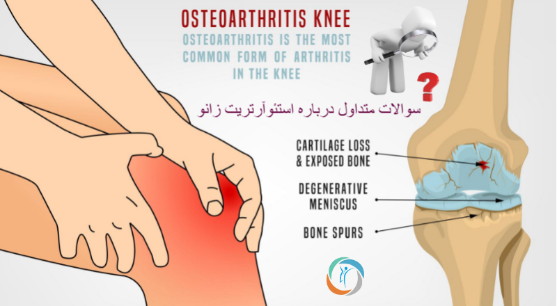 سوالات متداول درباره استئوآرتریت زانو