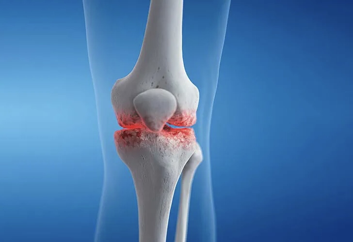 انواع آرتروز