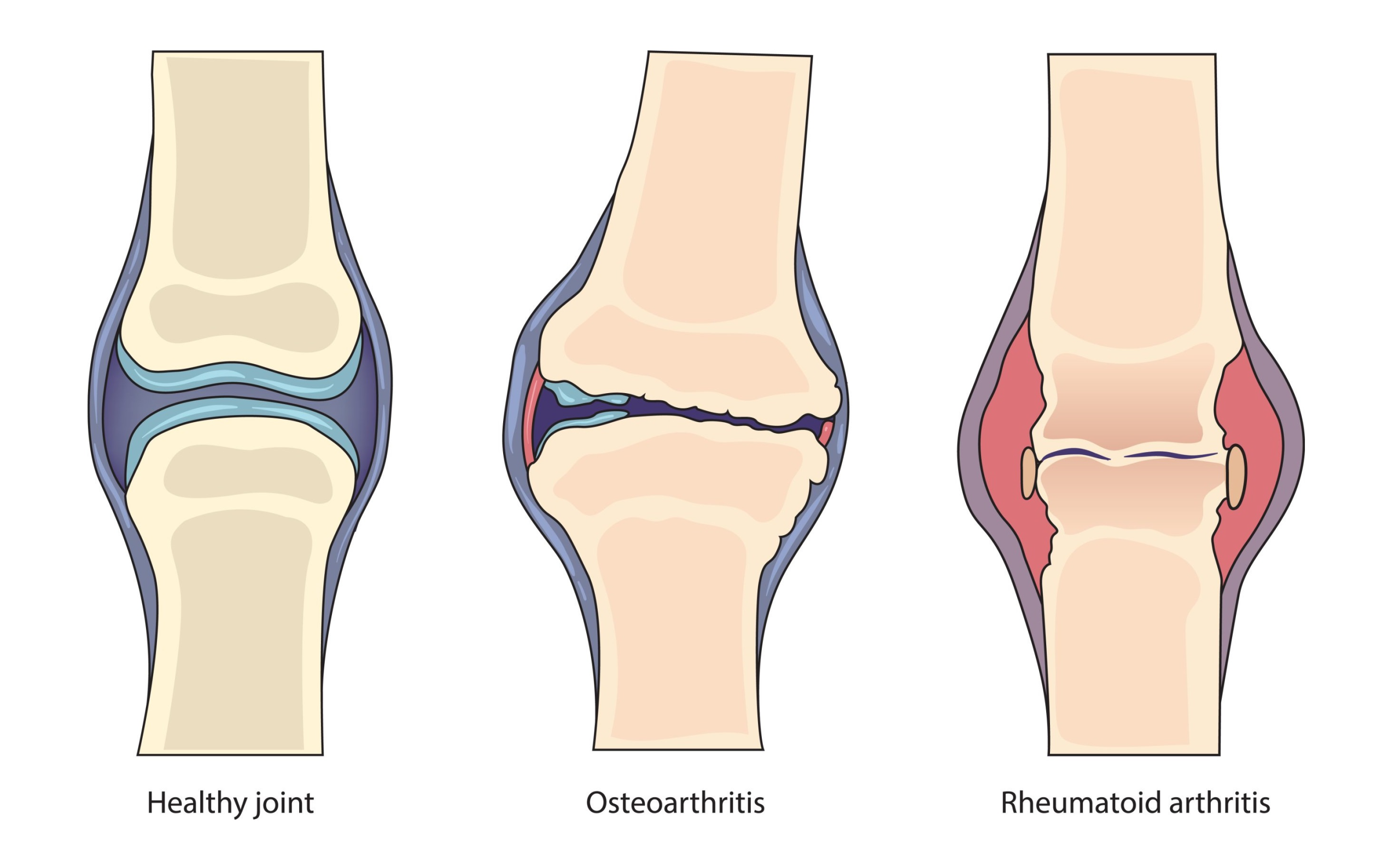 فرق آرتروز و آرتریت چیست؟