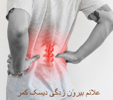 علائم بیرون زدگی دیسک کمر