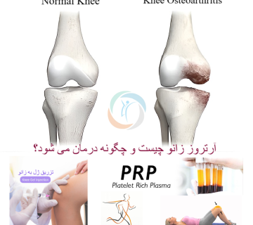 آرتروز زانو؛ درد زانو و ناتوانی راه رفتن