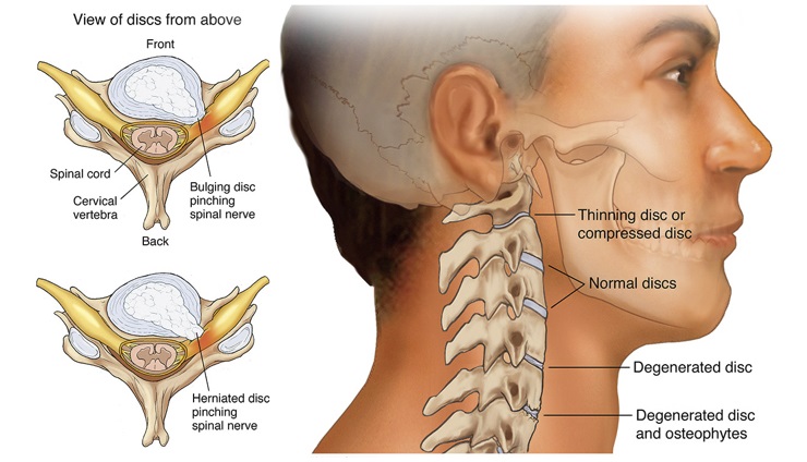 گردن درد و ورزش گردن
