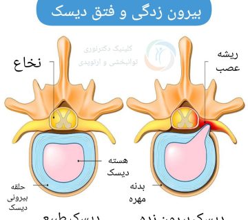 بیرون زدگی و فتق دیسک