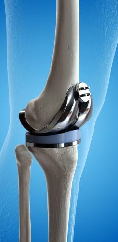 مفصل - تعویض مفصل