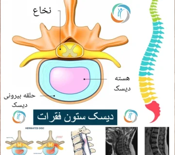 دیسک ستون فقرات