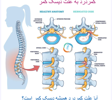 کمردرد به علت دیسک کمر