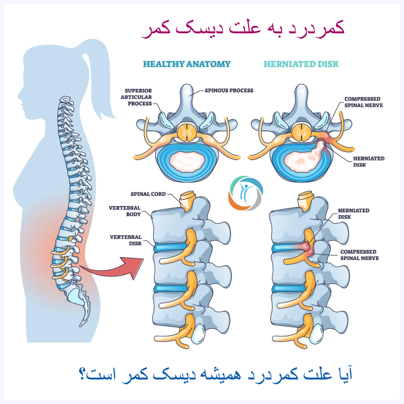 کمردرد به علت دیسک کمر