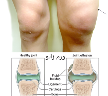 نظرات بیماران/ ورم زانو