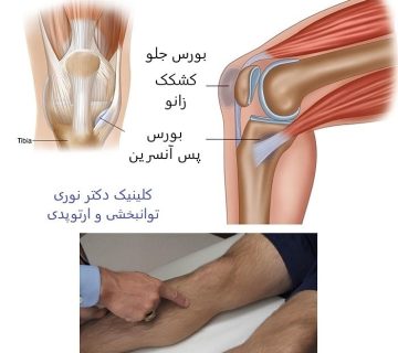 درد زیر زانو