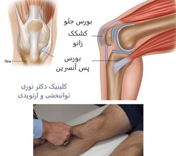 درد زیر زانو